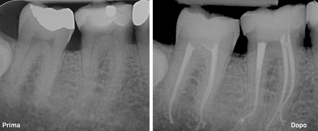 Devitalizzazione (cura canalare) di due denti: uno in pulpite ed uno con frattura della corona