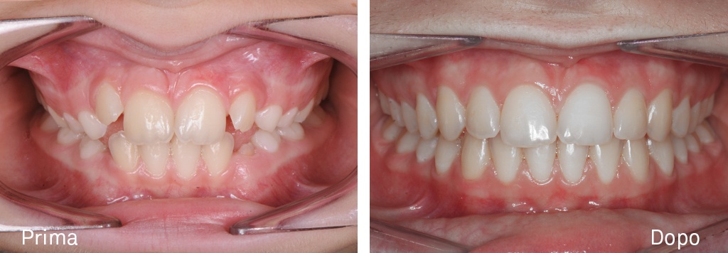 Caso di affollamento con morso aperto - Trattamento ortodontico intercettivo - seguito da una fase di apparecchio fisso