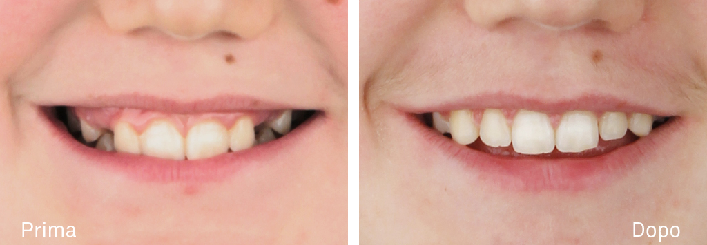 Trattamento ortodontico di un caso caratterizzato da una seconda classe molare e canina monolaterale