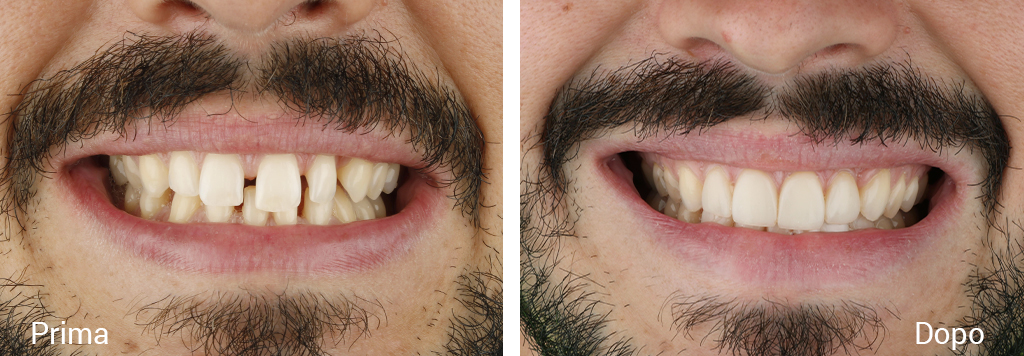 Trattamento ortodontico con Invisalign e ricostruzioni dirette in composito