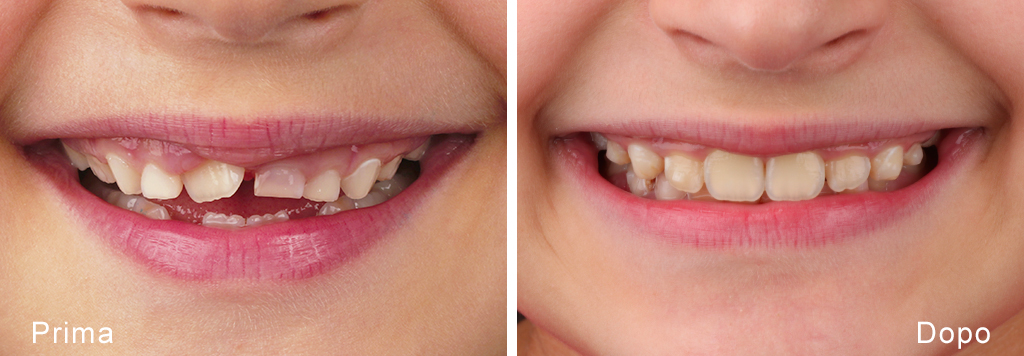 Ortodonzia intercettiva nei bambini con Invisalign First